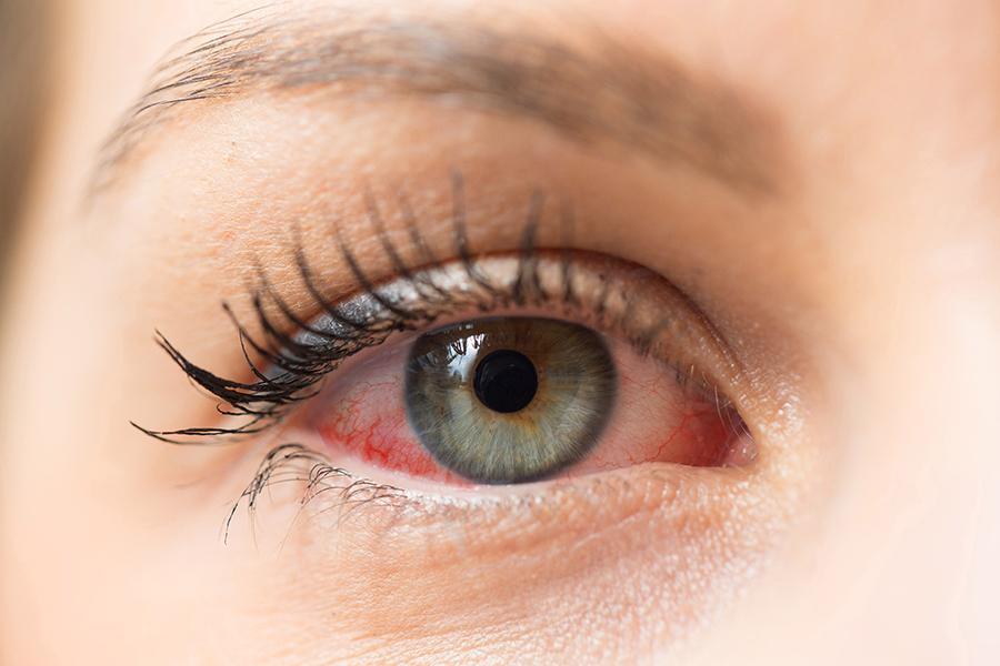 دلایل حساسیت چشم به آرایش